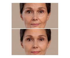 Revitalize Your Look: Blepharoplasty in Miami with Dr. John Martin