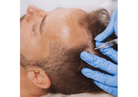 Before and After PRP Hair Treatment