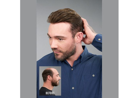 Hair Replacement Center in California