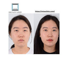 Enhance Your Beauty with Korean Double Eyelid Surgery at Mine Clinic