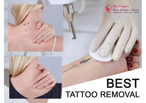 Best Laser Tattoo Removal in Bangalore - Guaranteed Results