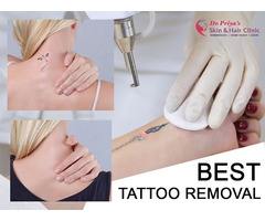 Best Laser Tattoo Removal in Bangalore - Guaranteed Results