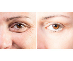 Achieve a Youthful and Rested Look with Top Blepharoplasty Surgeons