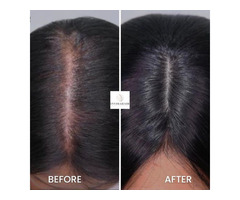 Hair Replacement System for Women