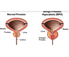 Benign Prostate Hypertrophy Treatment