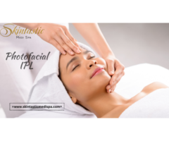 Top Notch Photofacial IPL in Riverside