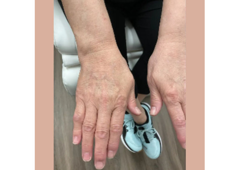 Effective Lumecca Ipl Treatment For Radiant Skin
