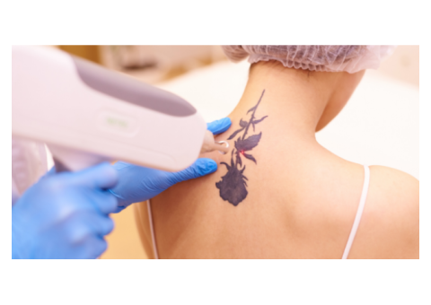 laser tattoo removal before and after