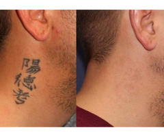 TATTOO REMOVAL HERBAL CREAM +27799196969, ILLINOIS