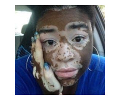 MAMA SARAH VITILIGO CURE +27799196969, MINNESOTA