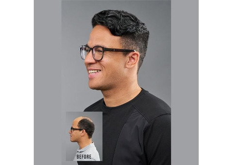 Men's Hair Restoration in Yorba Linda
