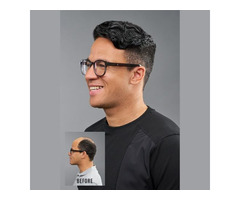 Men's Hair Restoration in Yorba Linda