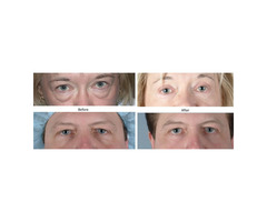 Blepharoplasty Surgery