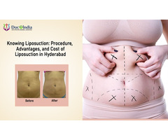 Affordable Liposuction Cost in Hyderabad for a Flawless Look