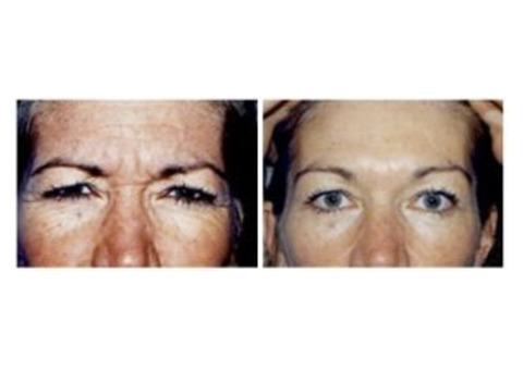 Botox Specialist Near Me