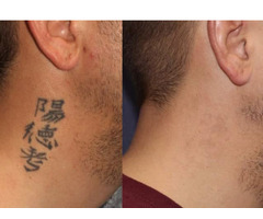 TATTOO REMOVAL CREAM +27799196969, USA,UK,CANADA,FRANCE ,SWEDEN