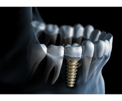 Restore Your Smile with Expert Dental Implants in Euless, TX