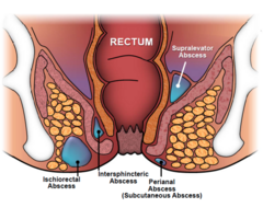 Best  piles clinic in delhi