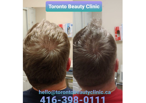 Best Hair Treatment For Receding Hairline