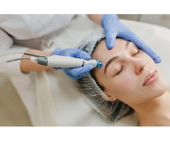 Transform Your Skin with Microneedling in Richmond Hill