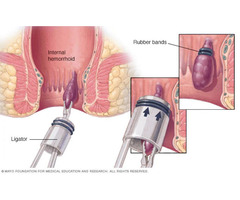 Best Hospital for Piles Treatment in Delhi