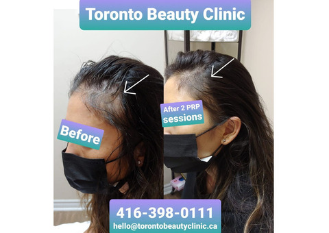 Are you Worried for Hair Loss During Postpartum Period?