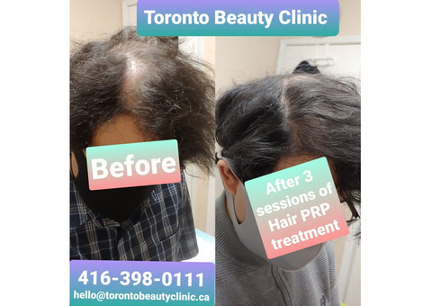 Affordable Hair Loss Solutions in Toronto – Customized for You