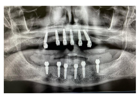 Dental crowns in Tijuana