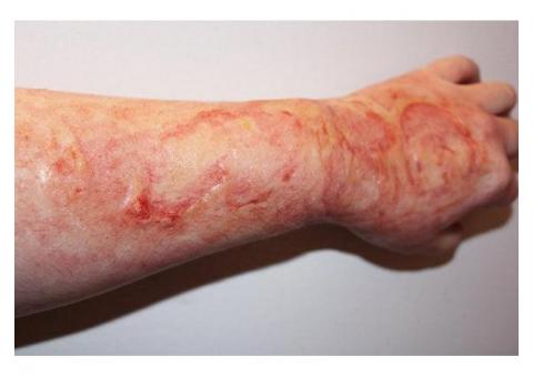 Services Offered By The Best Florida Burn Injury Lawyer