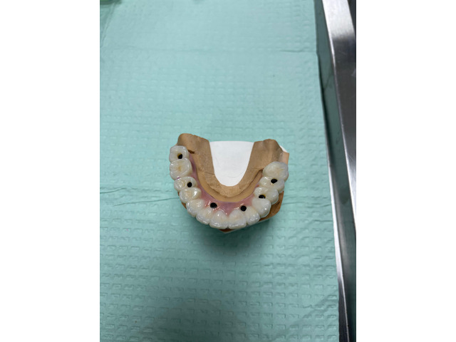 Dental implants Tijuana