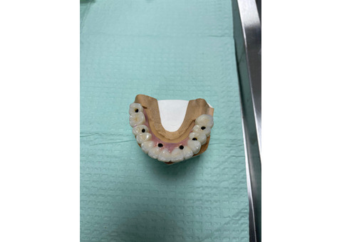 Dental implants Tijuana