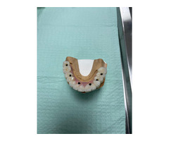 Dental implants Tijuana