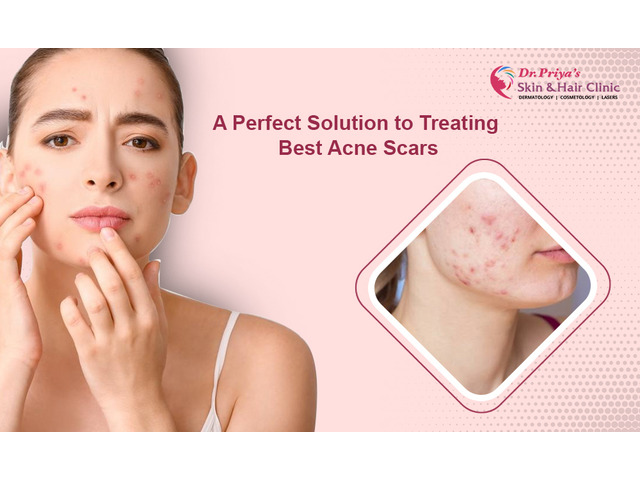 Say Goodbye to Acne – Try the Best Acne Removal Treatments