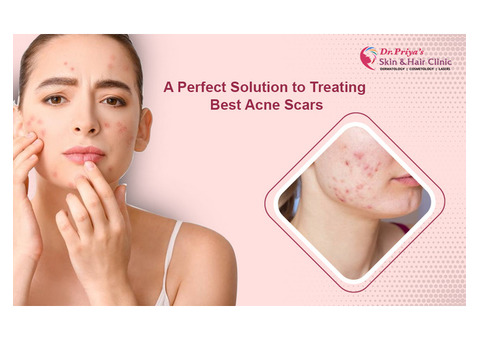 Say Goodbye to Acne – Try the Best Acne Removal Treatments