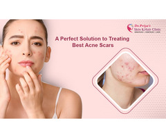 Say Goodbye to Acne – Try the Best Acne Removal Treatments