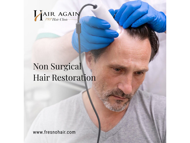 Non Surgical Hair Replacement For Men in Fresno