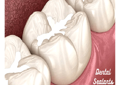 Dental sealants in The Colony
