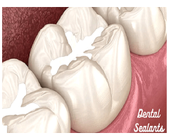 Dental sealants in The Colony