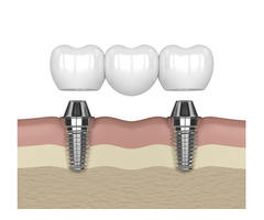 Your Trusted Dentist on Laurel St in Rancho Cucamonga