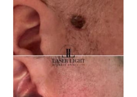 Laser removal of skin tag