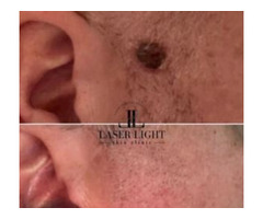 Laser removal of skin tag