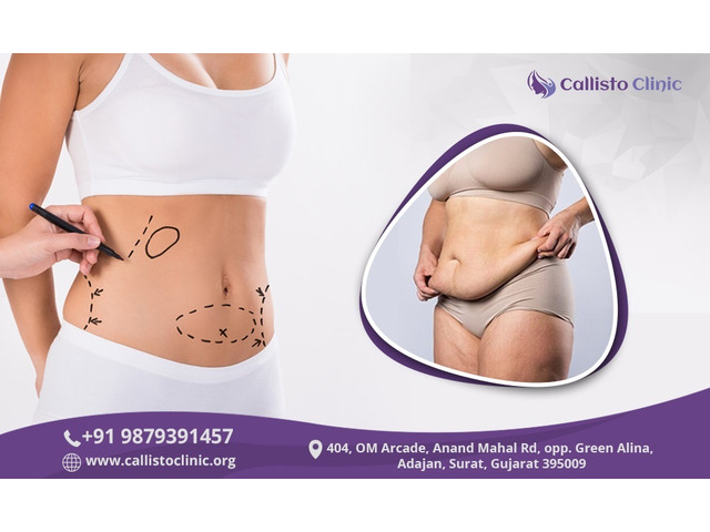 Liposuction in Surat – Callisto Clinic