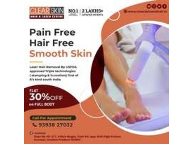 Laser Treatment For Birthmark Removal In India