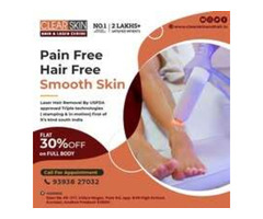 Laser Treatment For Birthmark Removal In India