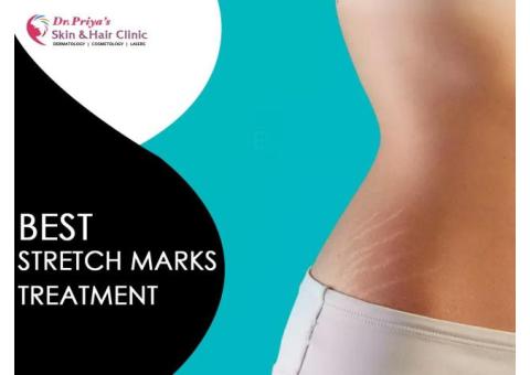 Best Stretch Marks Treatment In Marathahalli, Bangalore