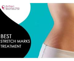 Best Stretch Marks Treatment In Marathahalli, Bangalore