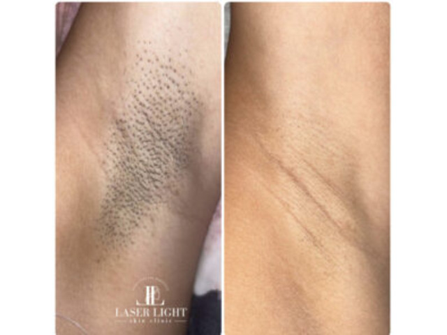 Laser hair removal east London