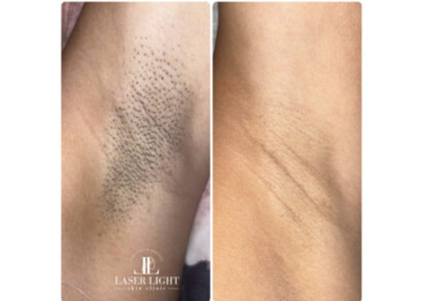 Laser hair removal east London