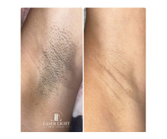 Laser hair removal east London