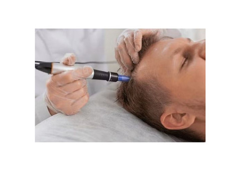 Stem Cell Therapy For Hair Loss